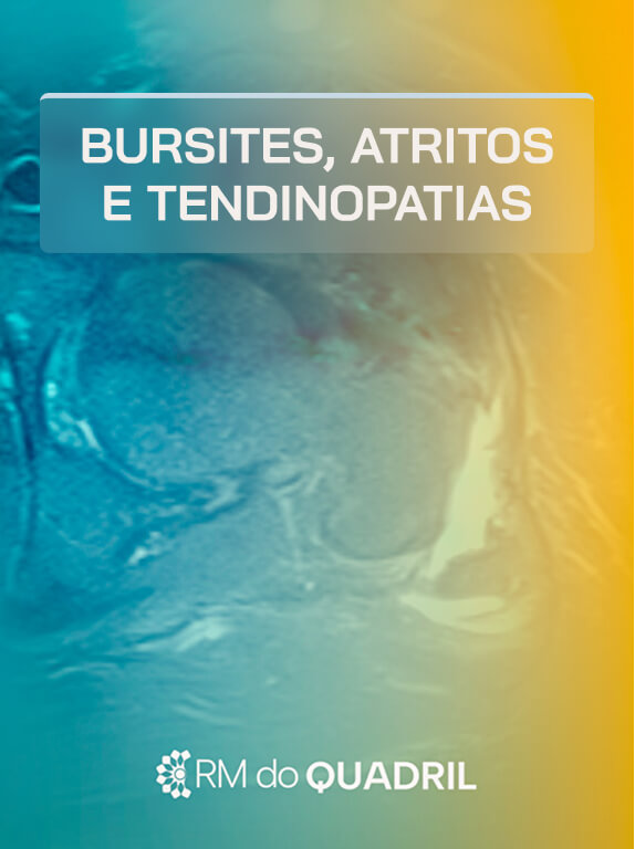 MÓD 4 - BURSITES, ATRITOS E TENDINOPATIAS