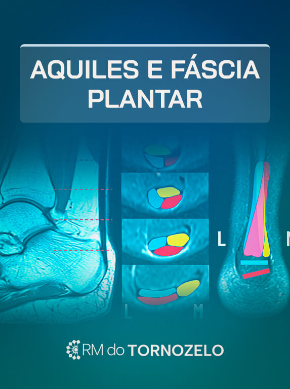 MÓD 6 - Aquiles e Fáscia Plantar