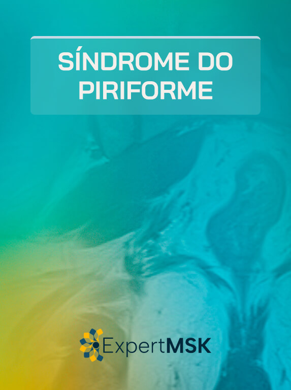 Síndrome do Piriforme